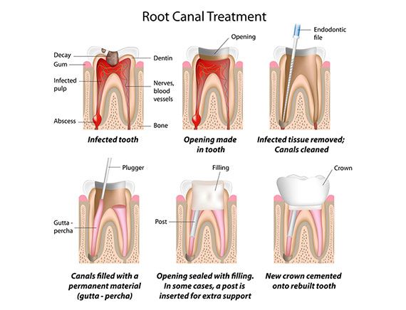 Endodontic Treatment