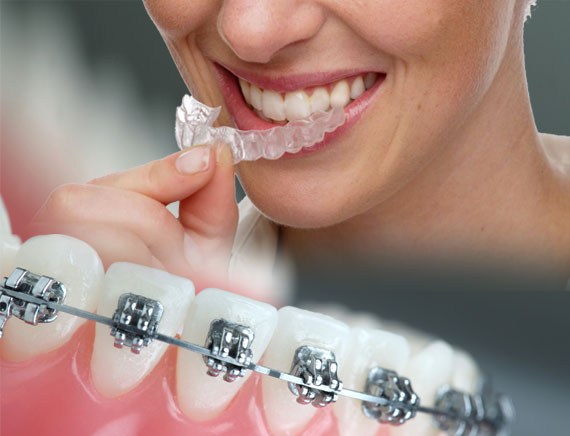 Orthodontic Treatment