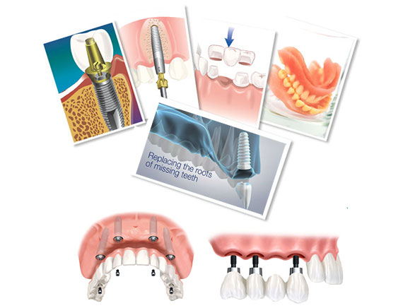 Prosthodontics (Dentures/Crowns)